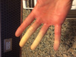 Raynauds-Disease