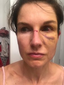 broken nose